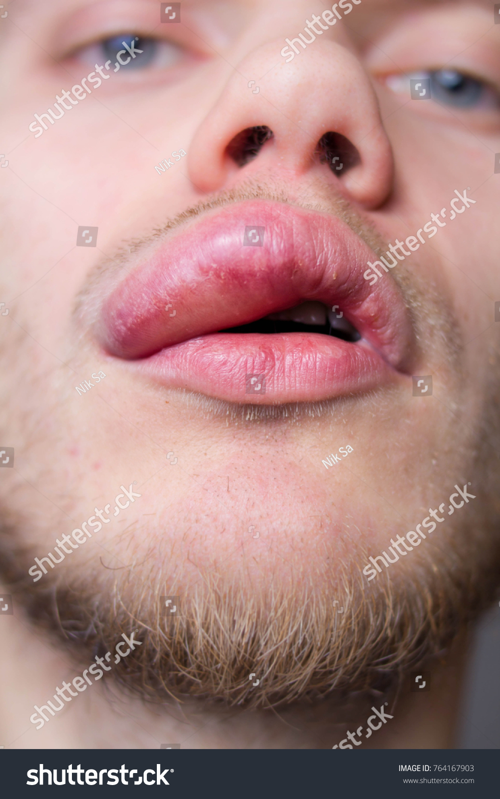 Allergic reaction rash above lip