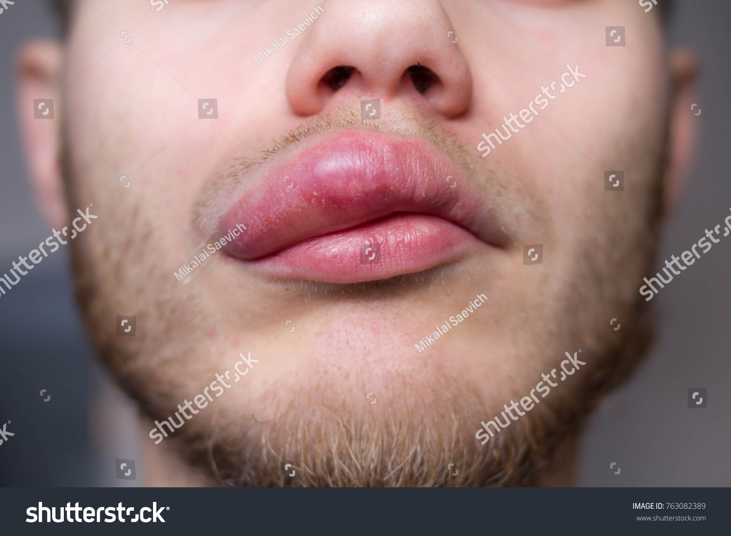 Lips Color Allergic Reaction at David Green blog