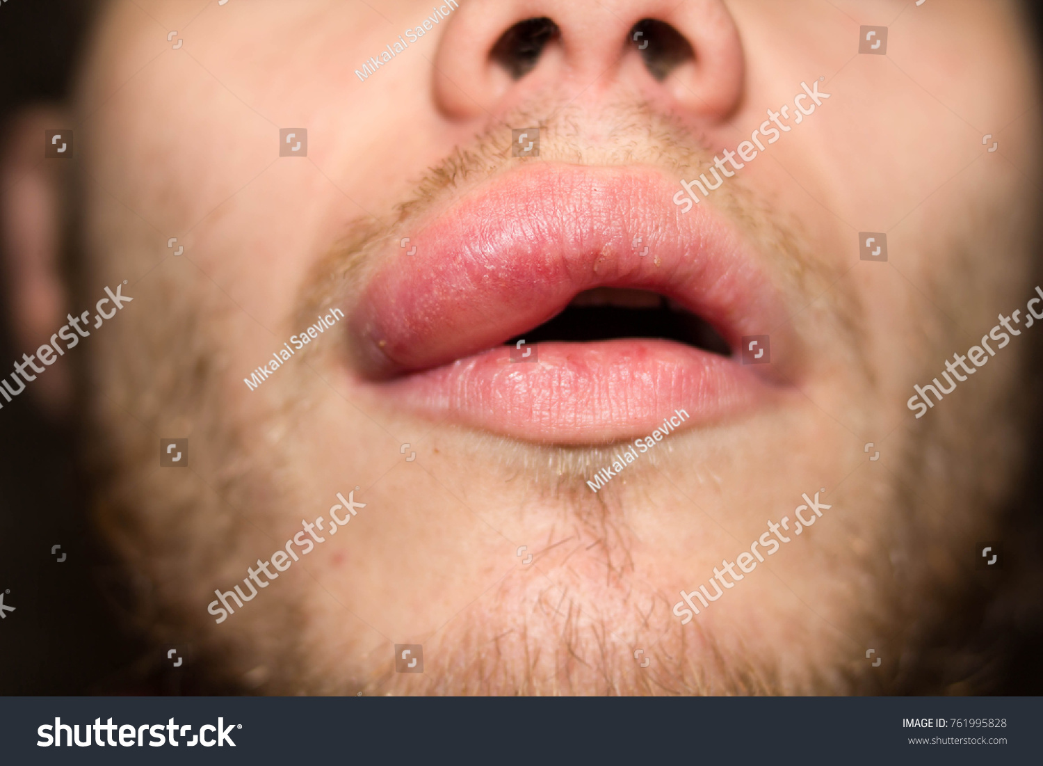 angioedema-allergic-reaction-lip-sick-guy-stock-photo-edit-now-761995828