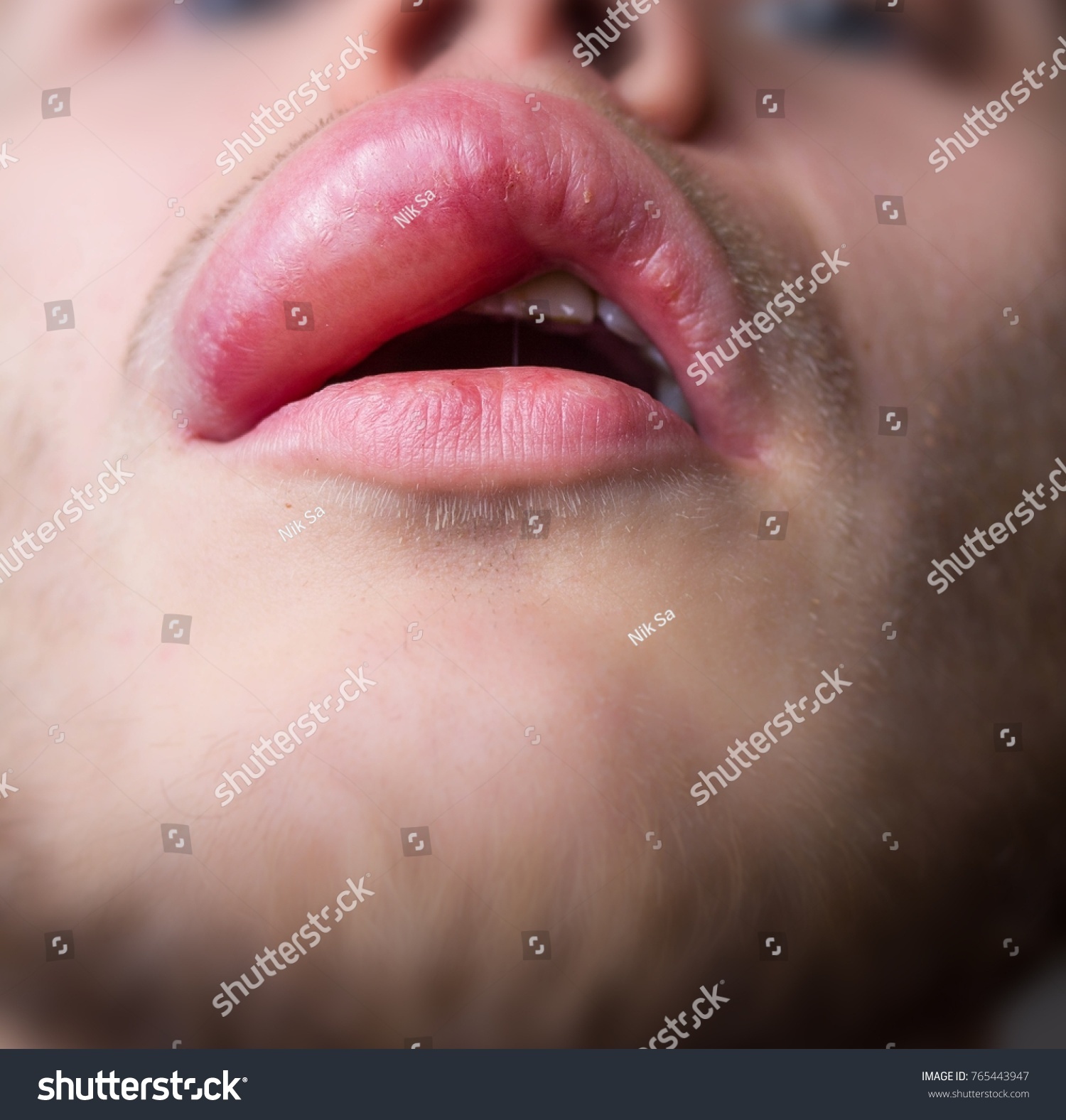 Angioedema Man On Upper Lip Allergic Stock Photo Edit Now 765443947