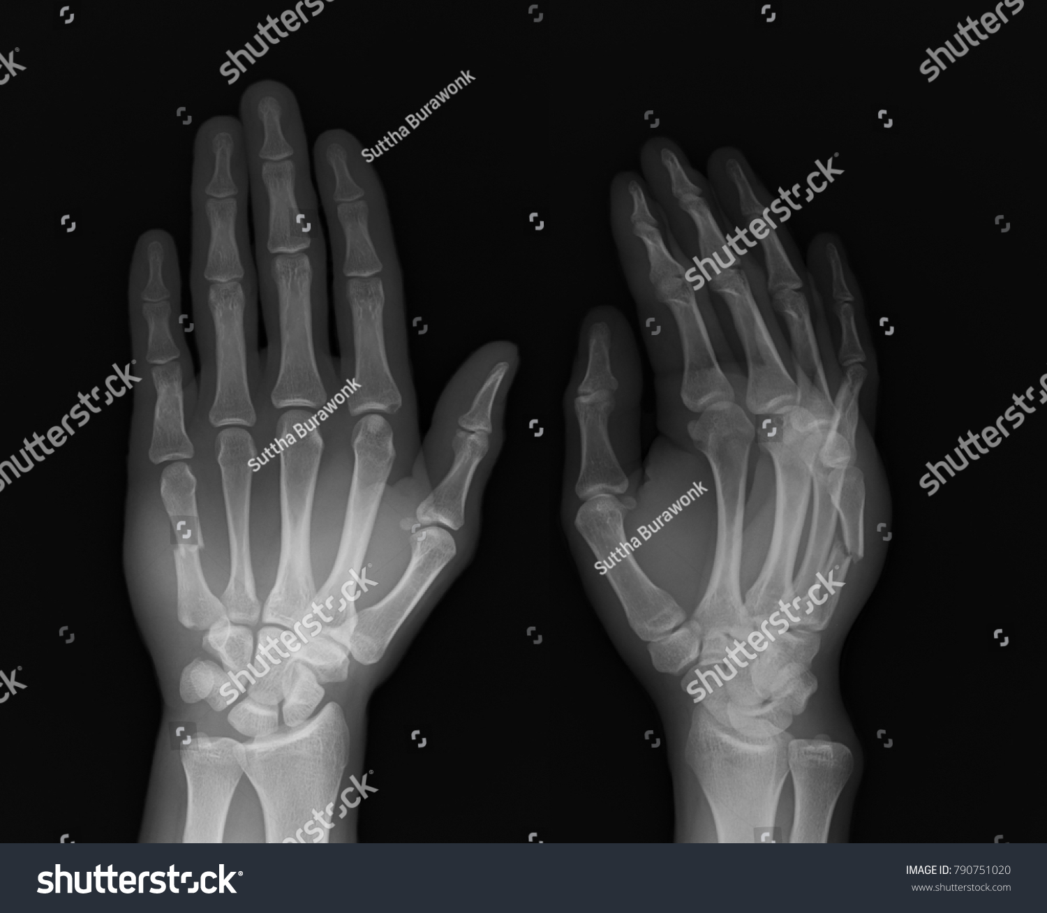 Anteroposteriorap Oblique Views Hand Xray Show Stock Photo 790751020 ...