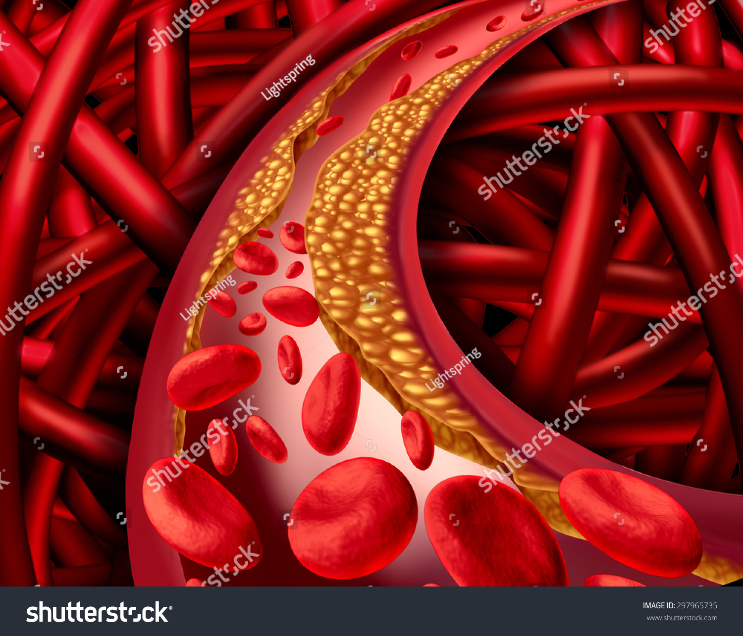 Artery Problem Clogged Arteries Atherosclerosis Disease Stock ...