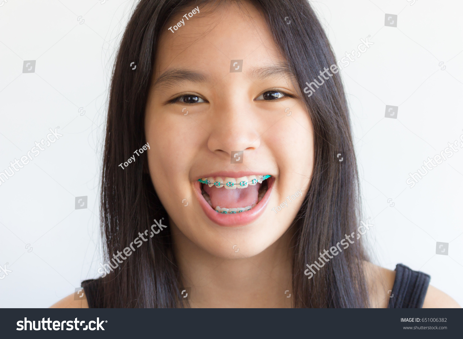 Asian Girl With Braces Telegraph