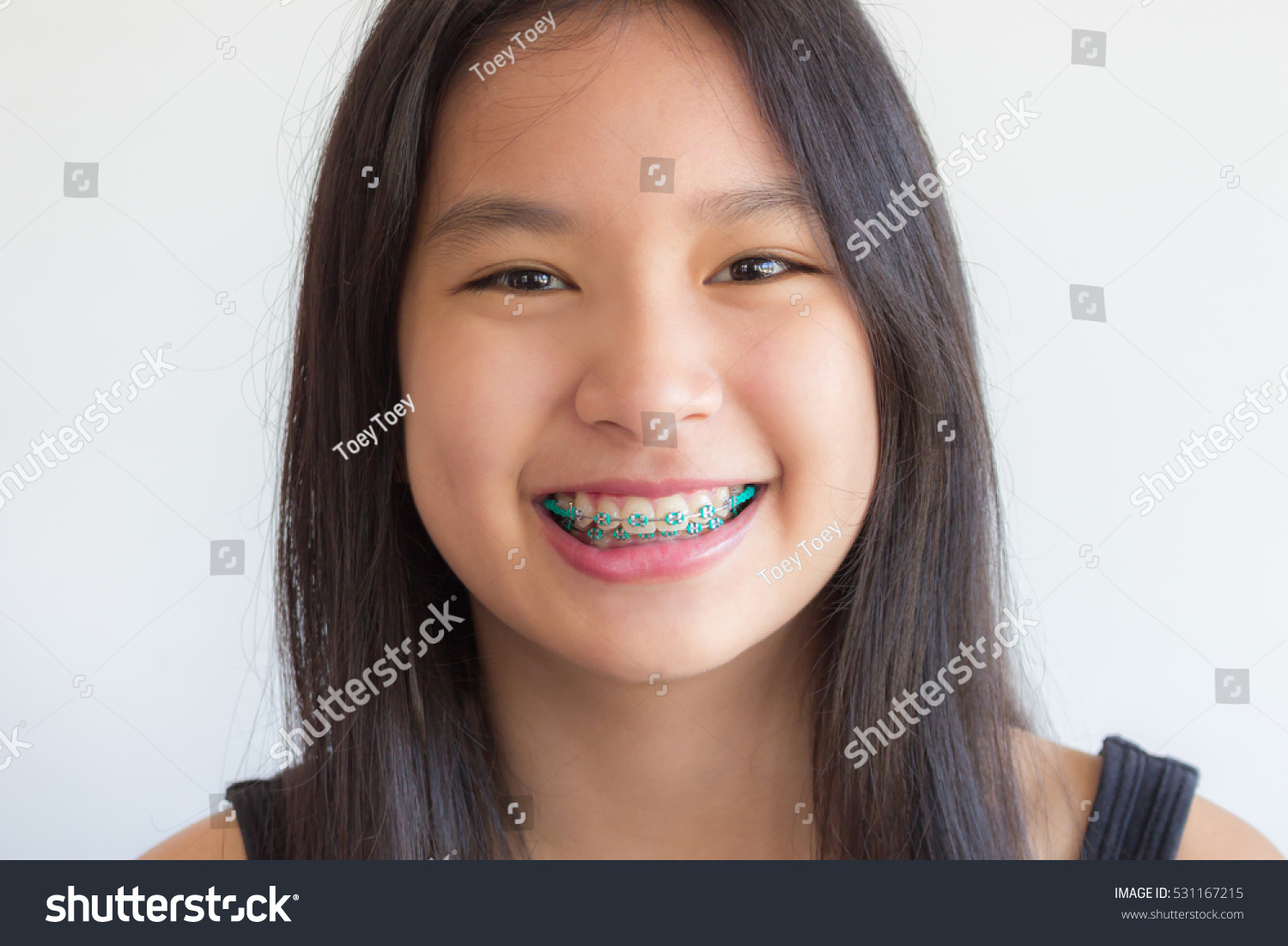 Girls With Braces Telegraph