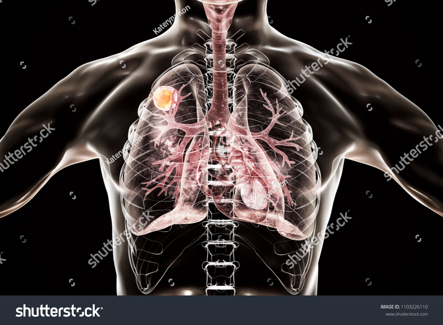 Aspergilloma Lung 3d Illustration Known Mycetoma Stock Illustration ...