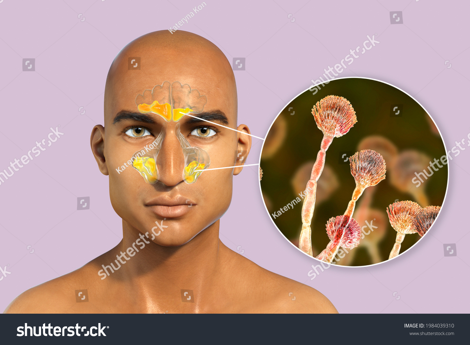 Aspergillus Fungi Cause Sinusitis 3d Illustration Stock Illustration ...