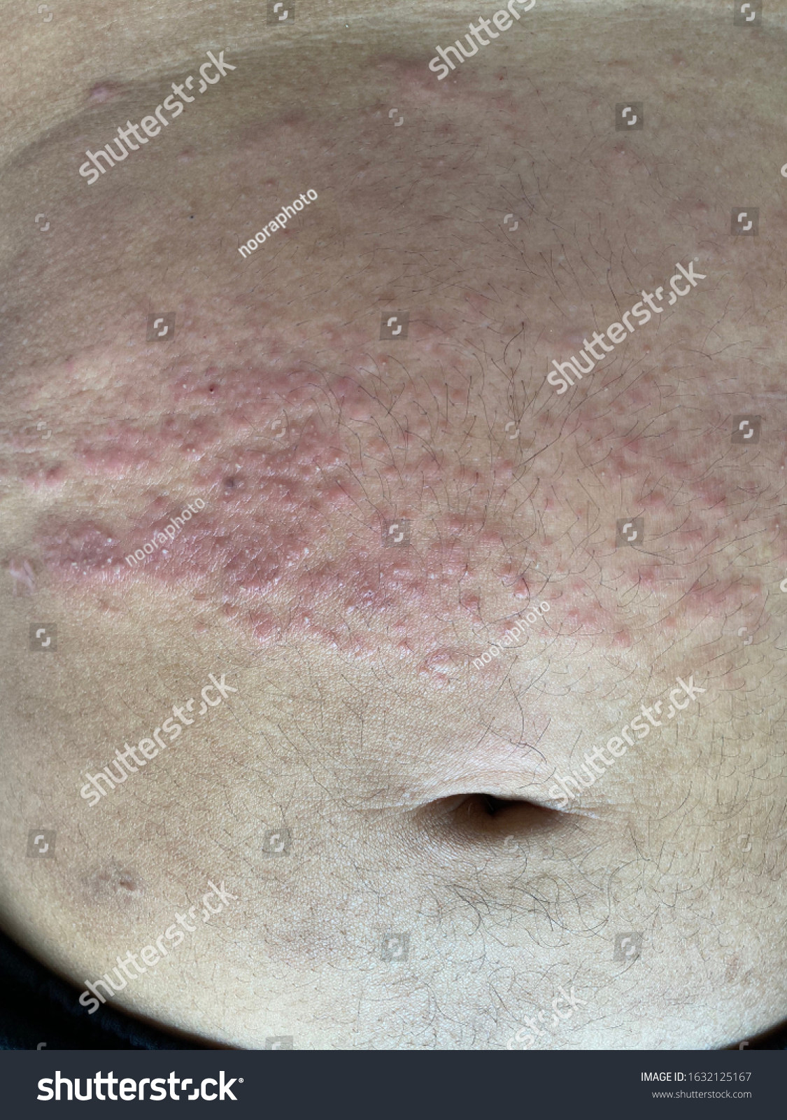 Atopic Dermatitis Skin Rashes On Abdomen Foto Stock 1632125167 Shutterstock