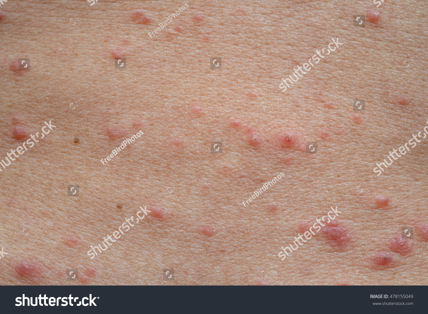 Atopic Dermatitis Symptom Skin Detail Texture Stock Photo Shutterstock