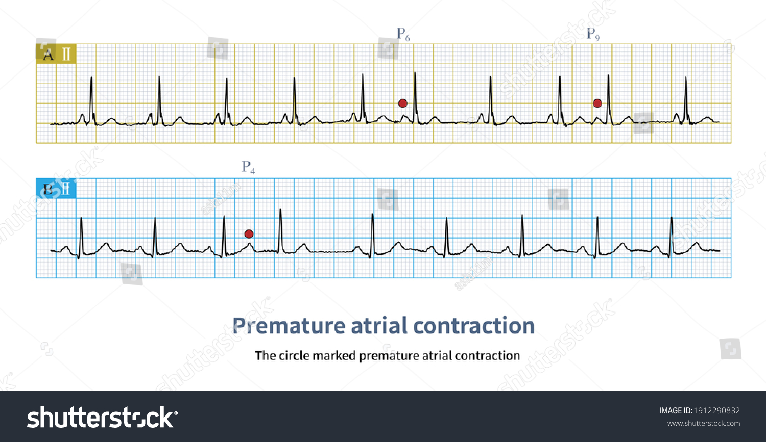 201 Atrial premature contraction Images, Stock Photos & Vectors ...