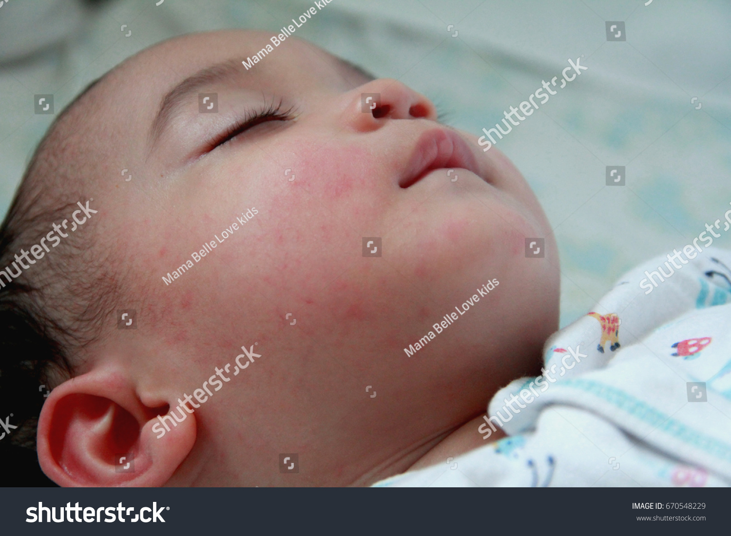 Baby Fever: Baby Fever Blister On Lip