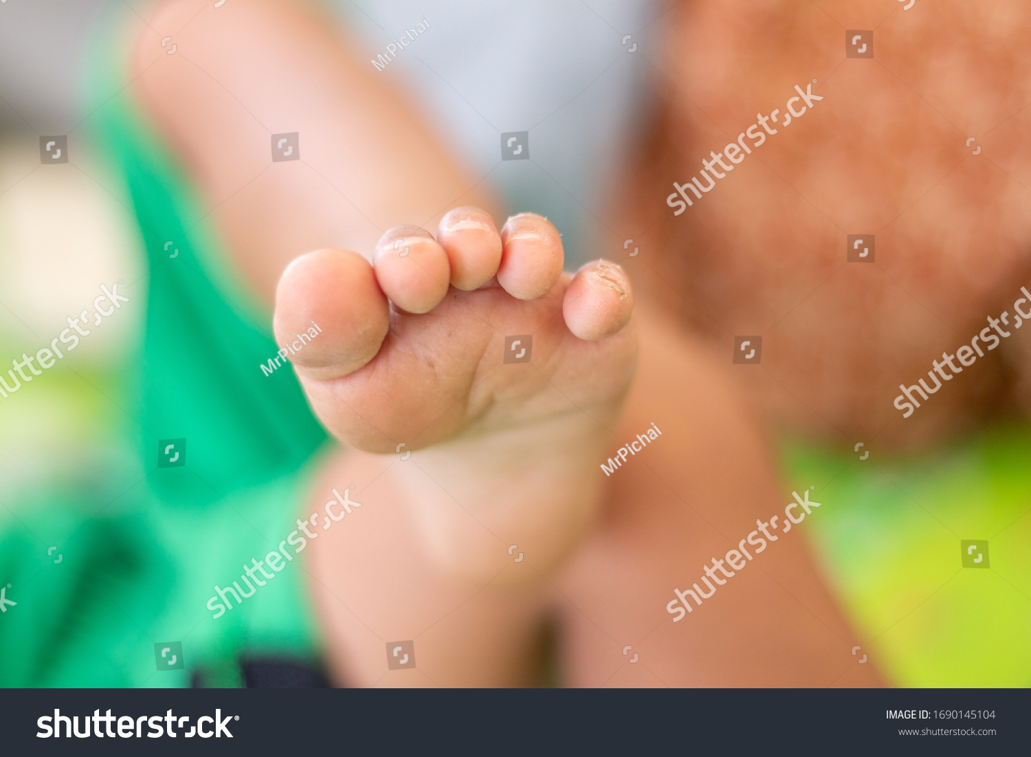 baby-feet-toes-have-scars-on-stock-photo-1690145104-shutterstock