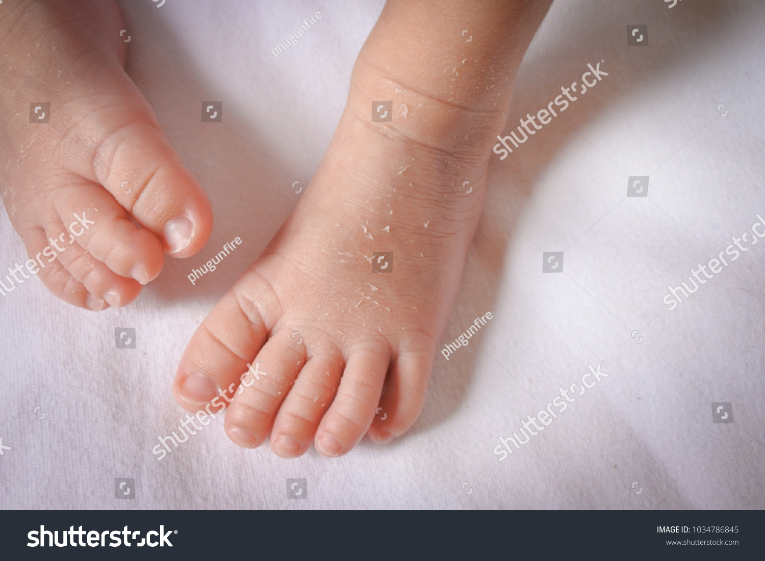 Baby Feet Dry Out Skin Baby Stock Photo 