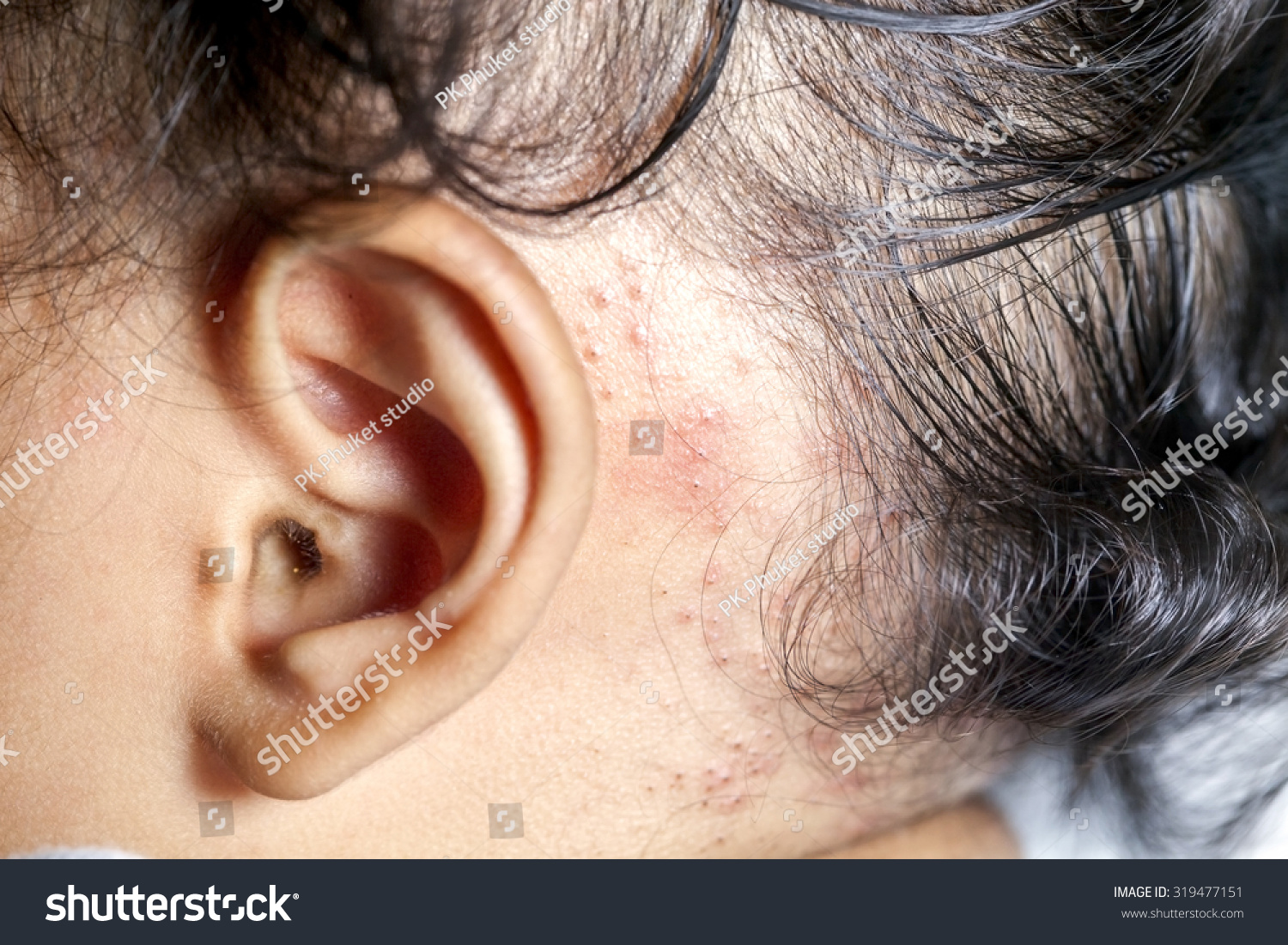 Baby Girl 11 Month Ill Allergic Stock Photo 319477151 - Shutterstock