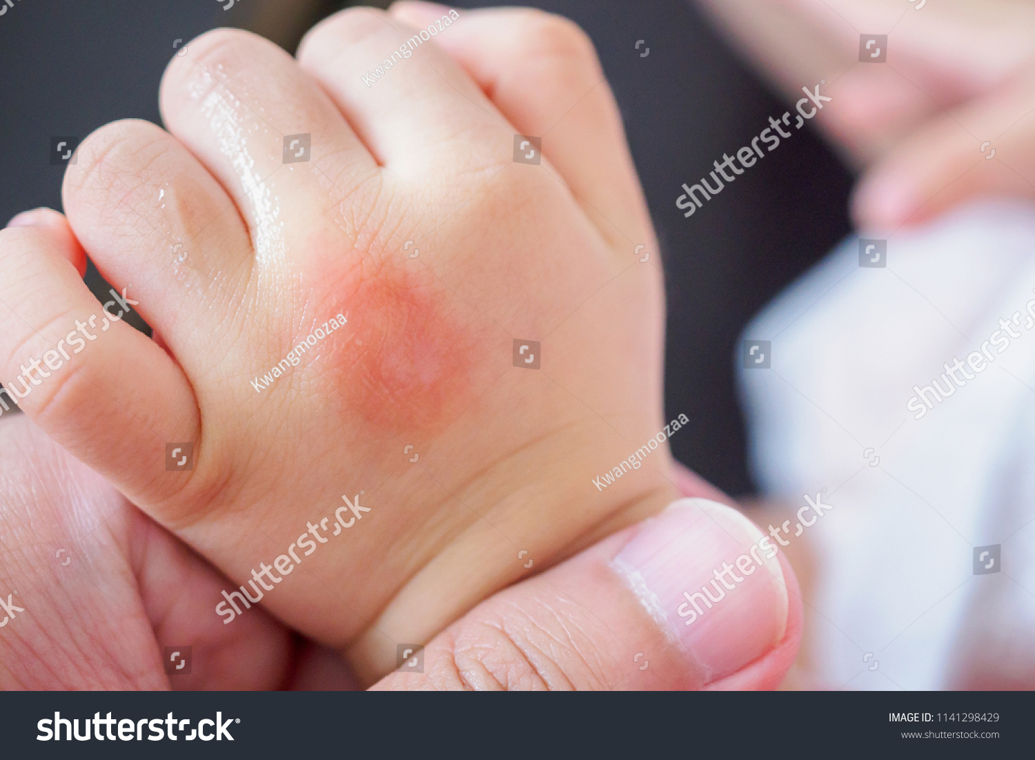 baby-hand-skin-rash-allergy-red-stock-photo-1141298429-shutterstock