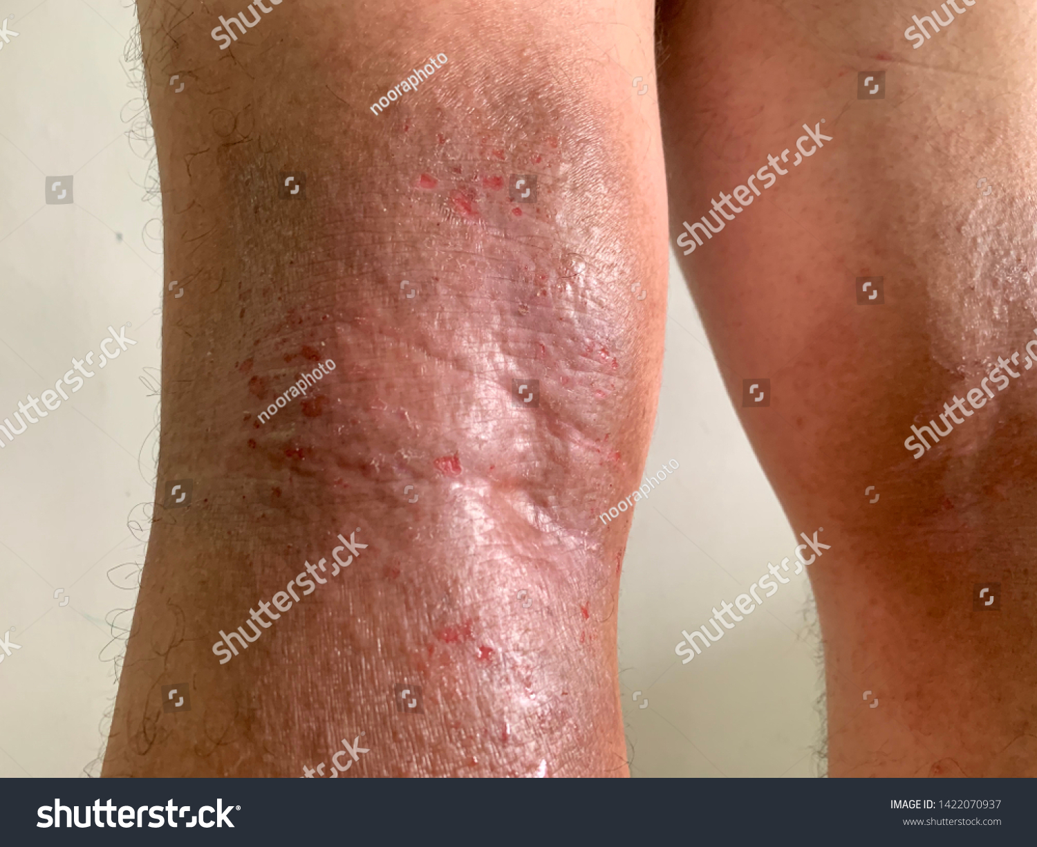 Back Knees Atopic Eczema Causes Areas Stock Photo Edit Now 1422070937