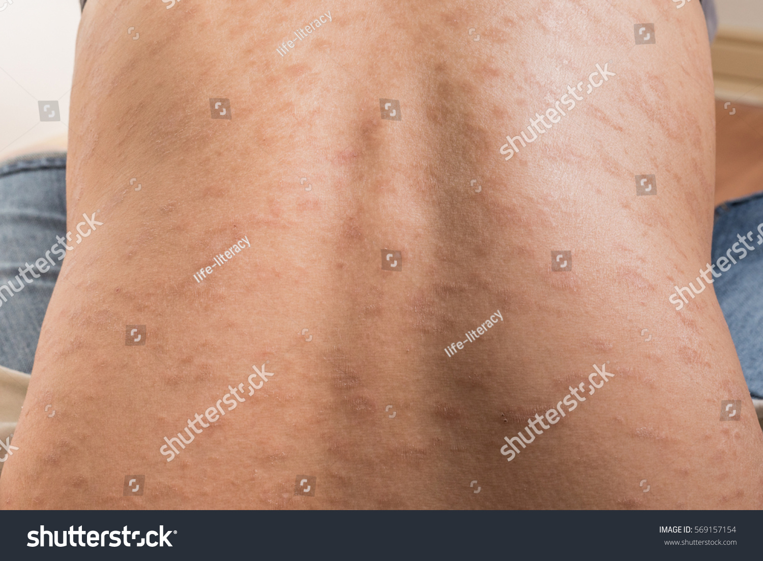 Back View Woman Dermatitis Problem Rash Foto Stock 569157154 Shutterstock