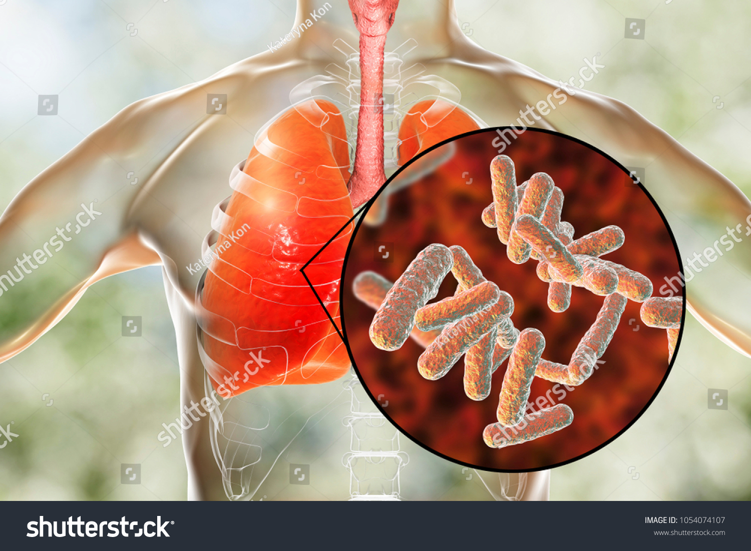 Bacteria Pneumonia Medical Concept 3d Illustration Stock Illustration 