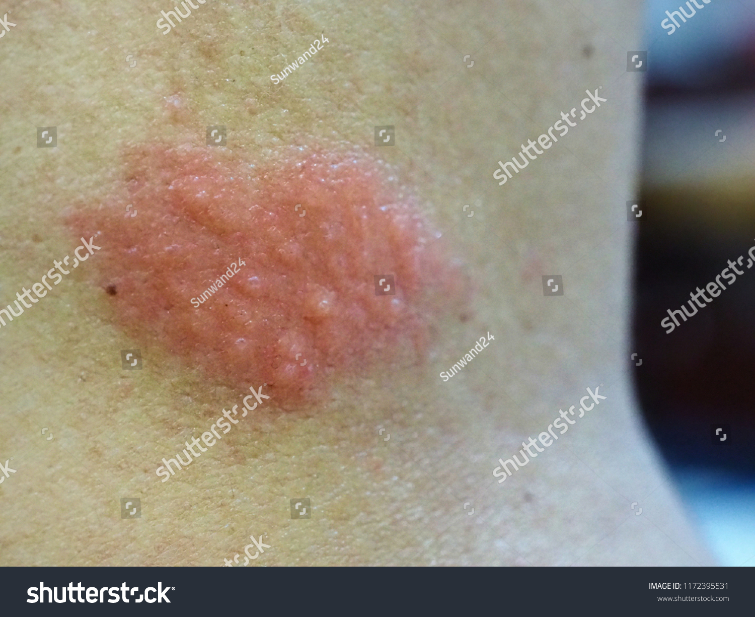 Bacterial Skin Infection Cause Widespread Red Stock Photo (Edit Now