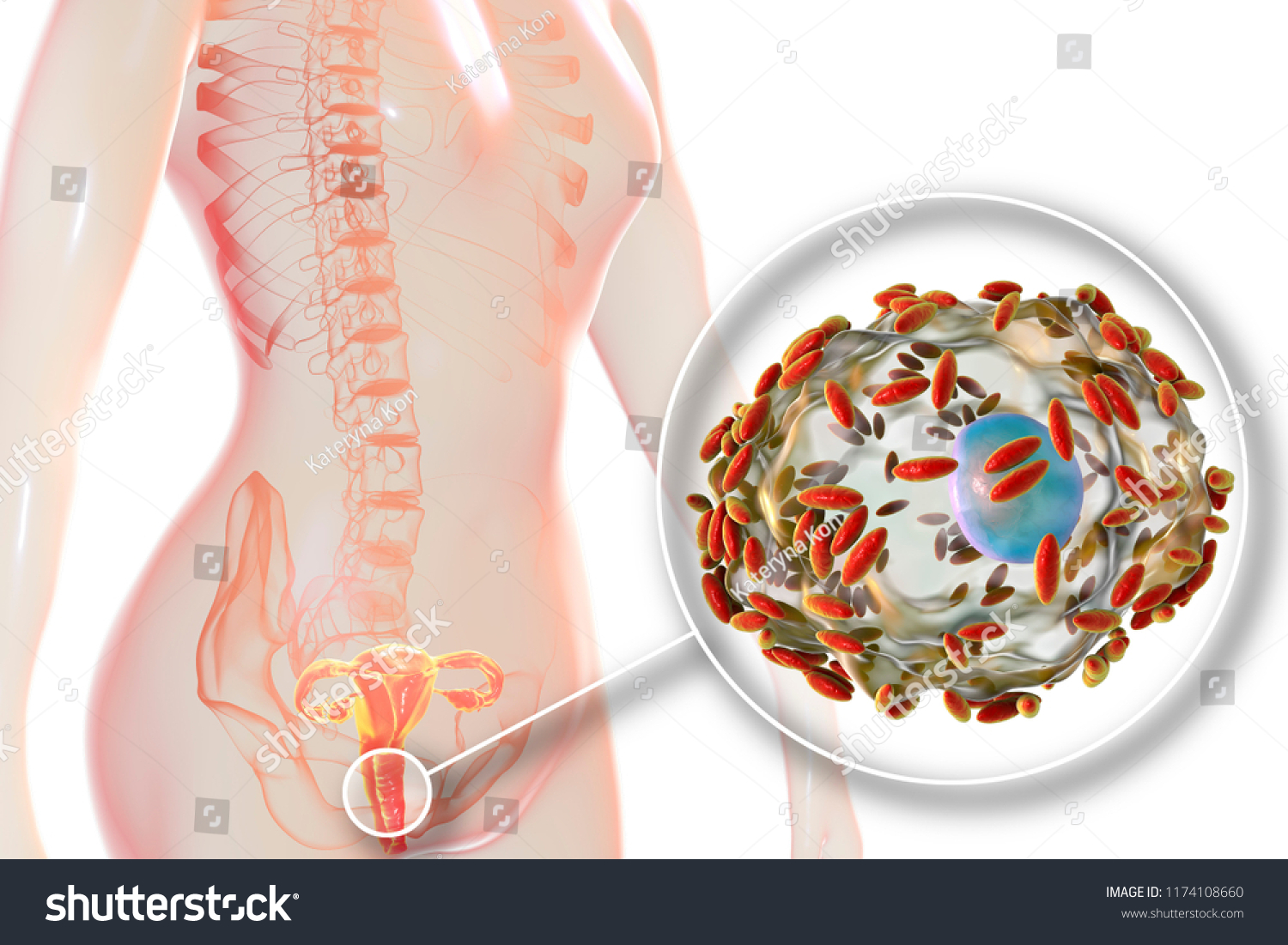 Bacterial Vaginosis Vaginal Secretions Contain Epithelial Stock Illustration 1174108660