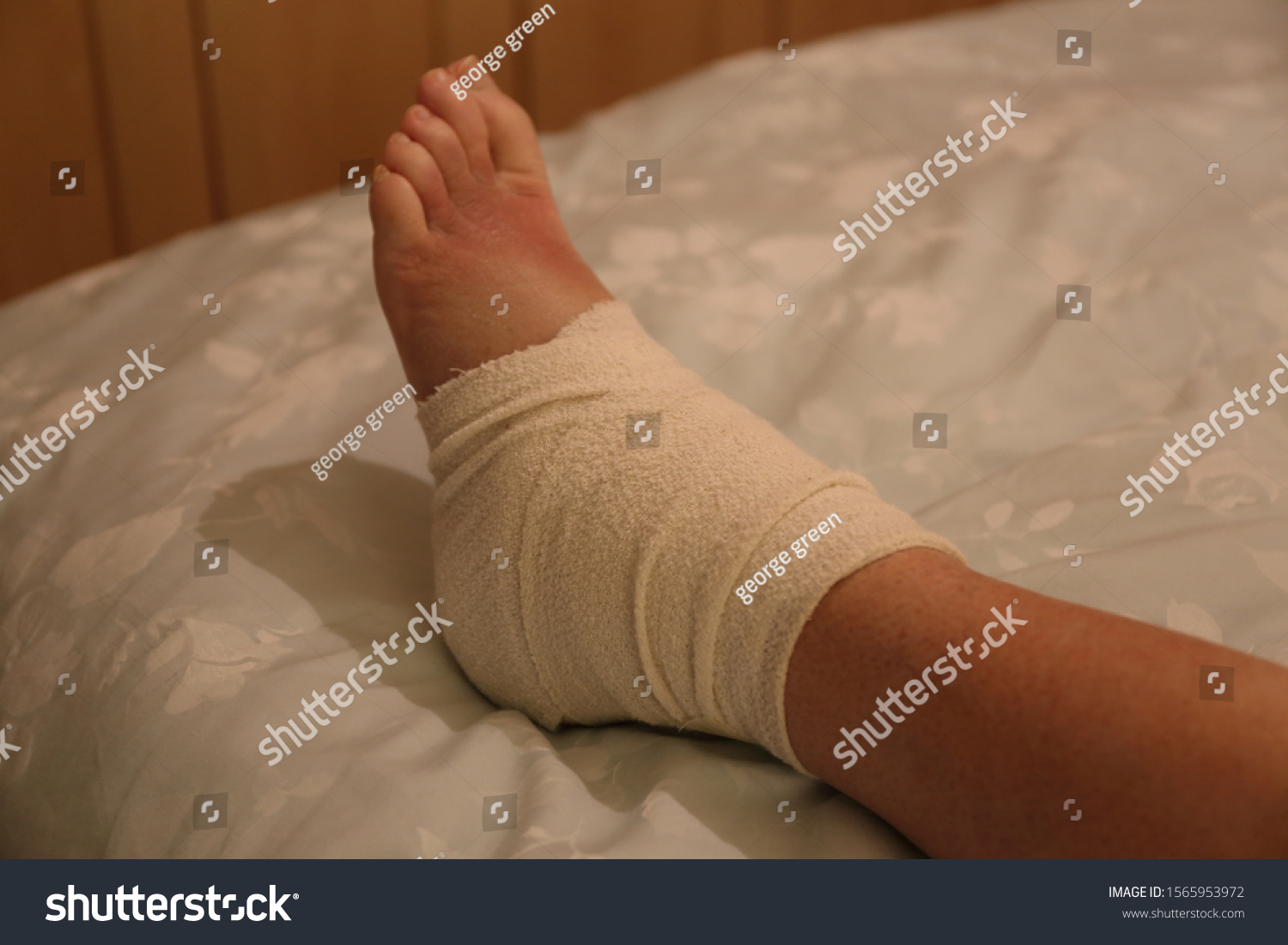 Bandaged Ankle Bruised Foot After Injury Stock Photo 1565953972 ...