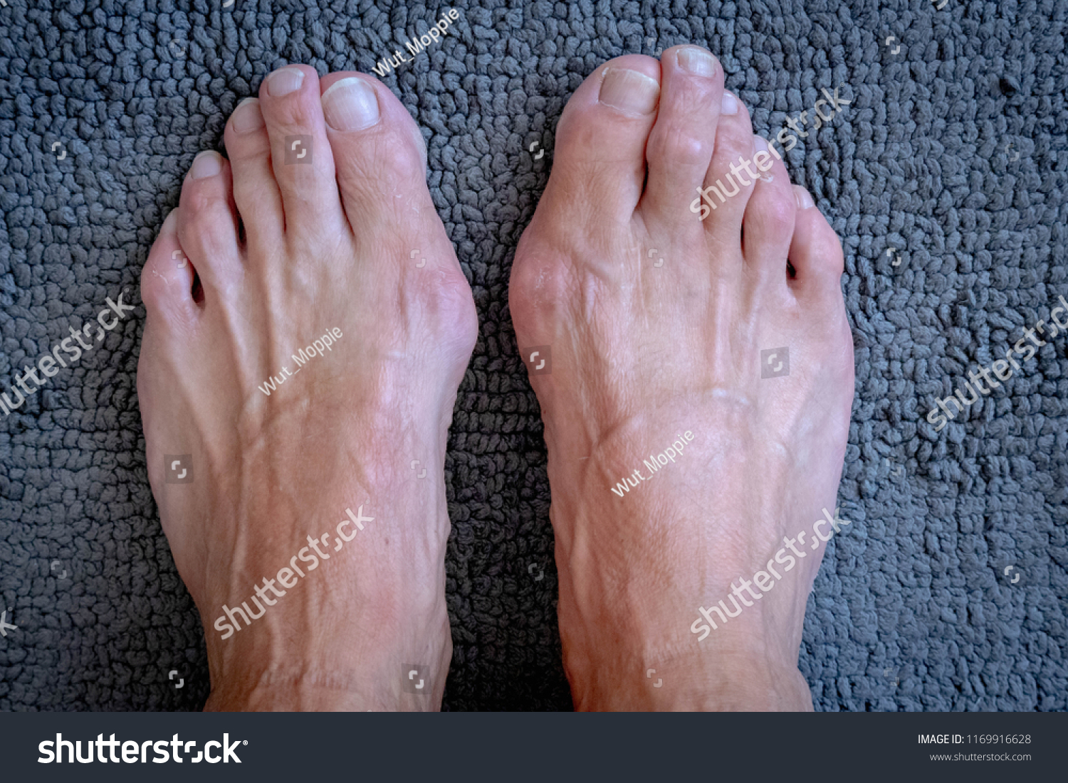 bunions on men's feet