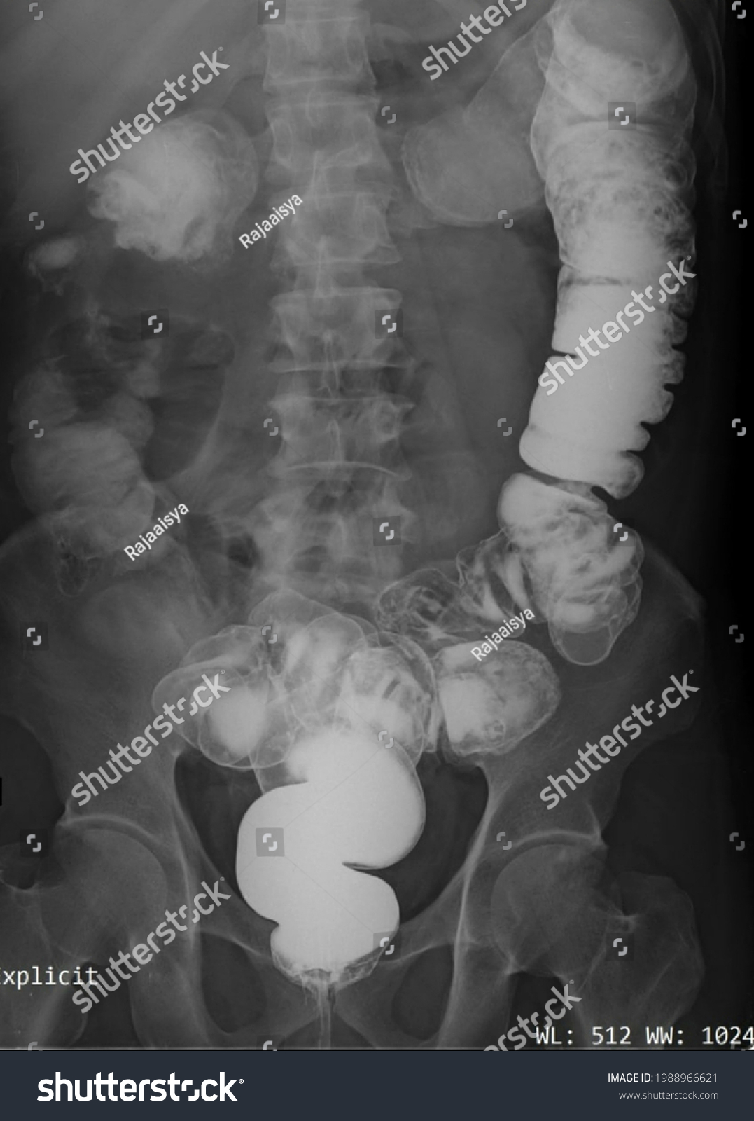 Barium Enema Colorectal Cancer Contrast Study Stock Photo 1988966621 ...