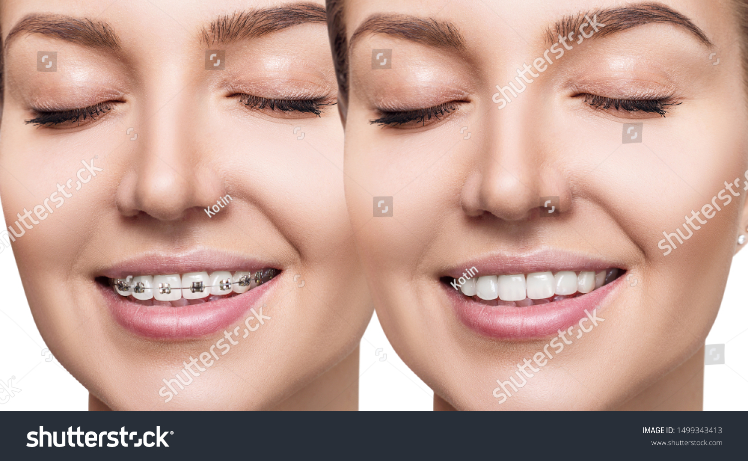 Beautiful Woman Smiling Perfect Teeth Before Stock Photo 1499343413 ...