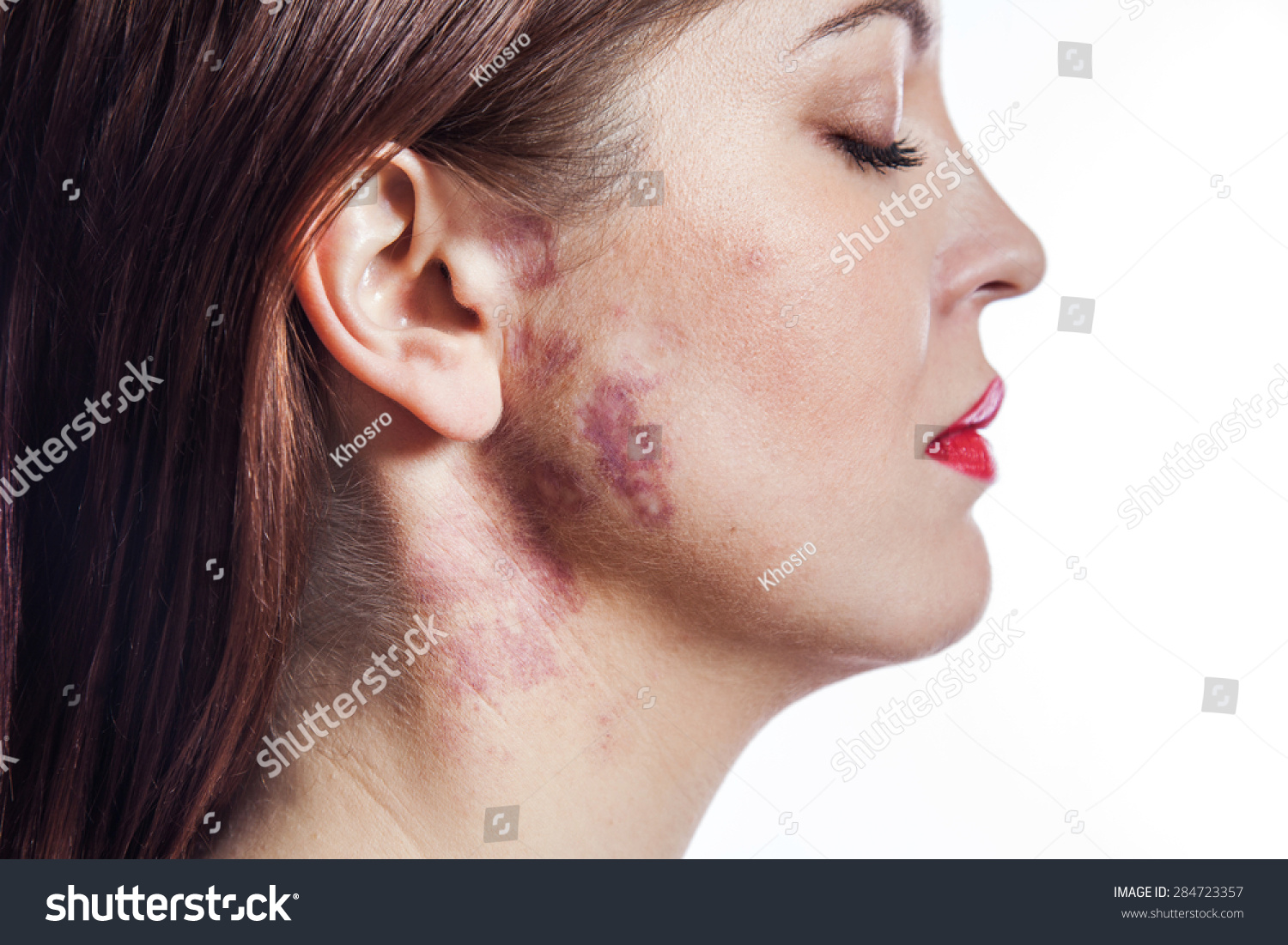 5 Midline nevus flammeus Images, Stock Photos & Vectors | Shutterstock
