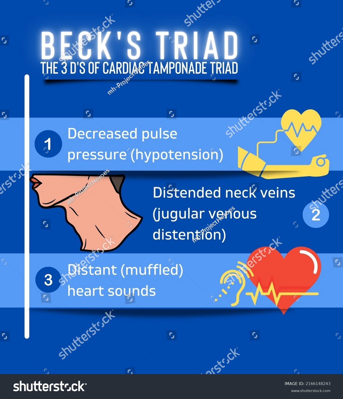 Becks Triad 3ds Cardiac Tamponade Poster Stock Illustration 2166148243 ...