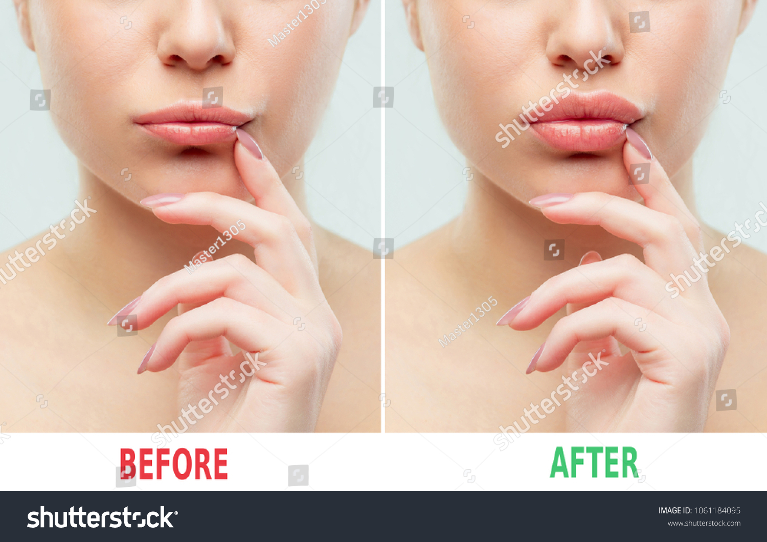 Sebelum Dan Sesudah Suntikan Bibir Filler Foto Stok 1061184095