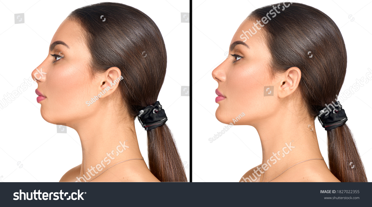 Receding Chin Images, Stock Photos & Vectors | Shutterstock