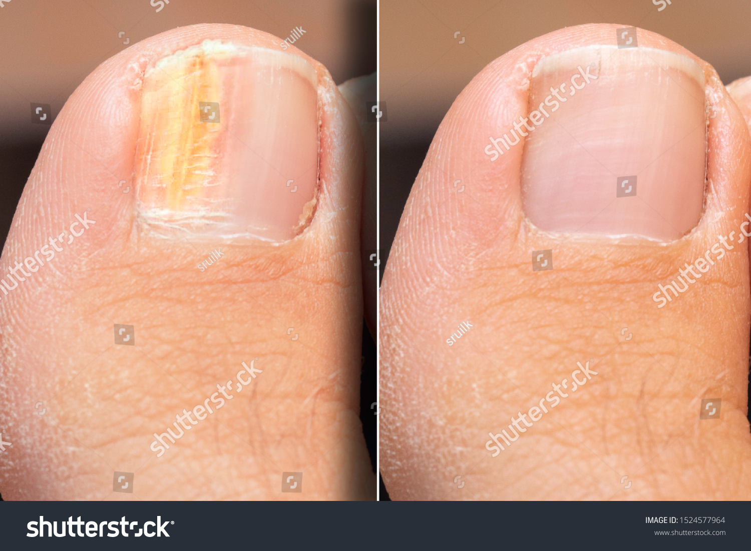 before-after-successful-treatment-fungal-infection-stock-photo