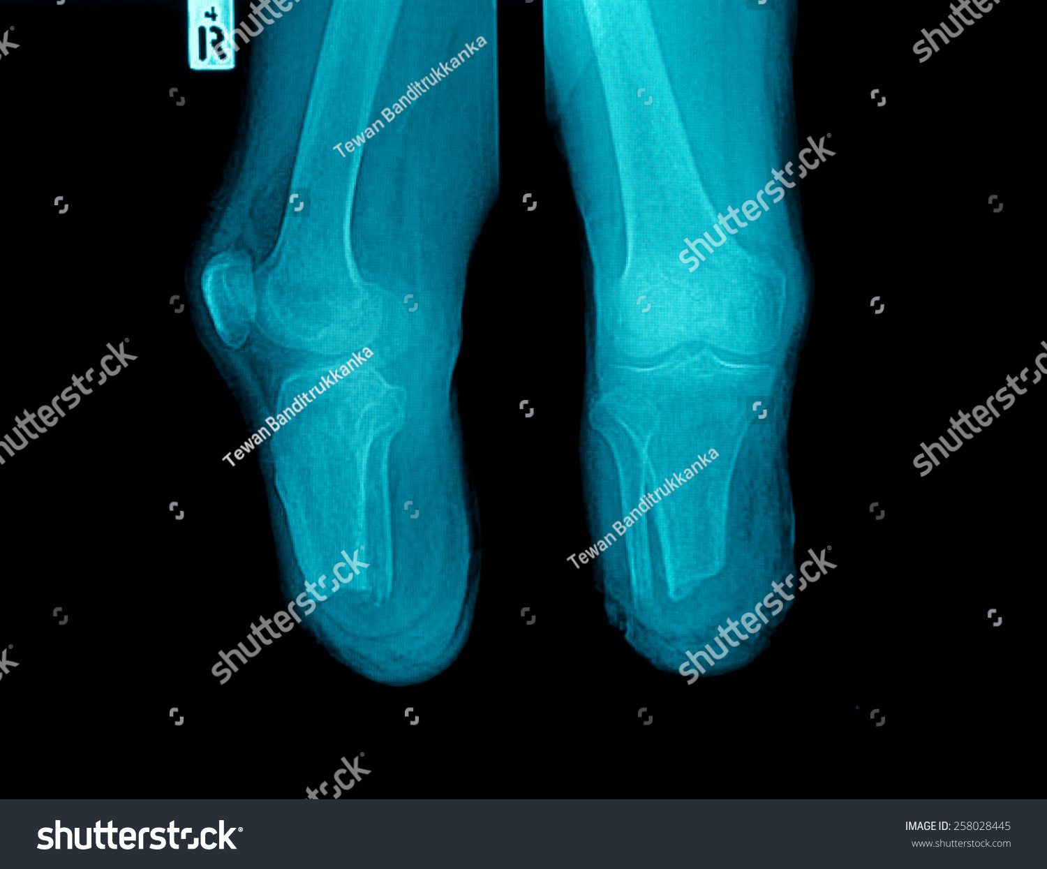 Below Knee Amputation Stump. Stock Photo 258028445 : Shutterstock