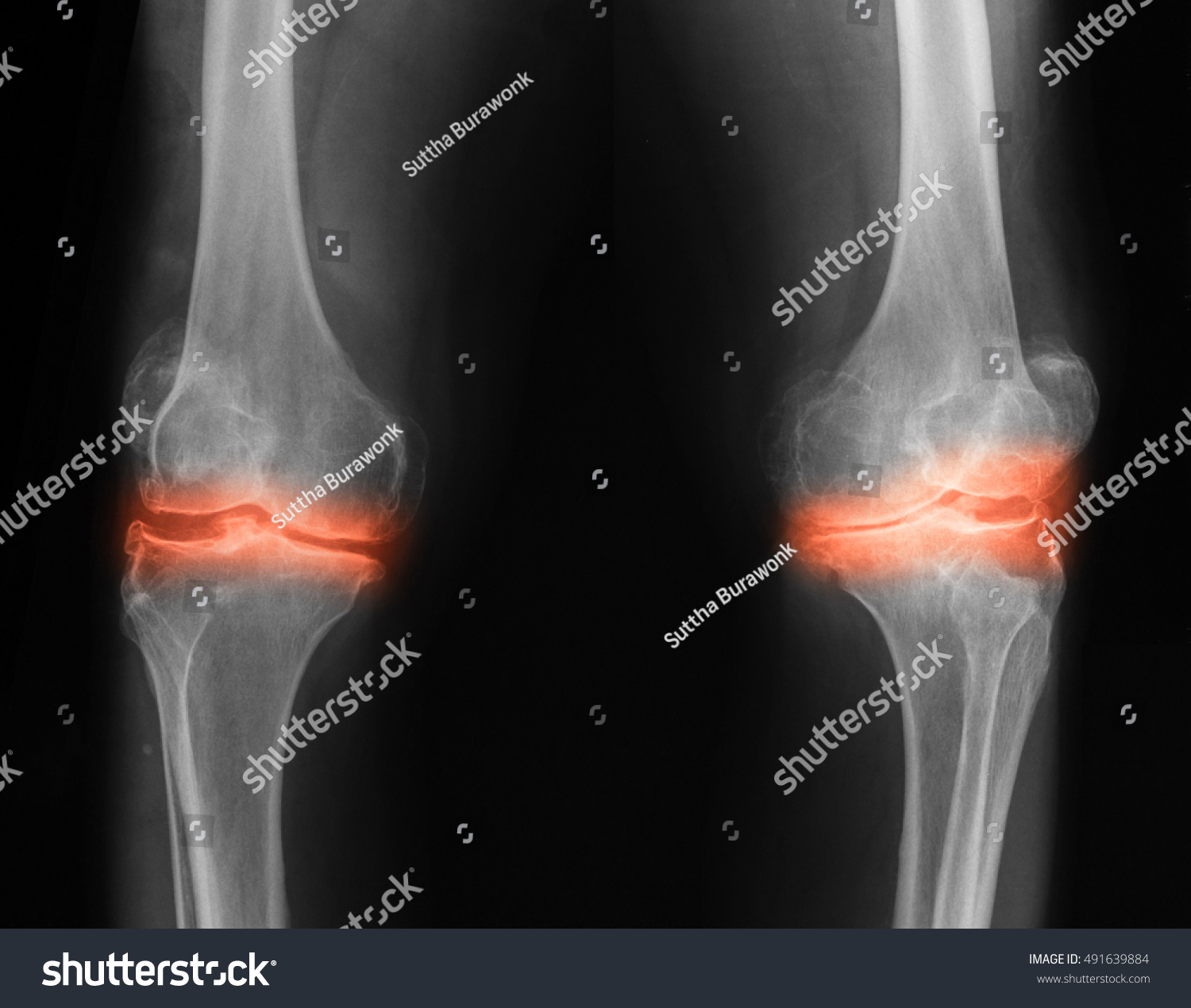 Bilateral Osteoarthritis Knee Joint Xray Image Stock Photo 491639884 ...