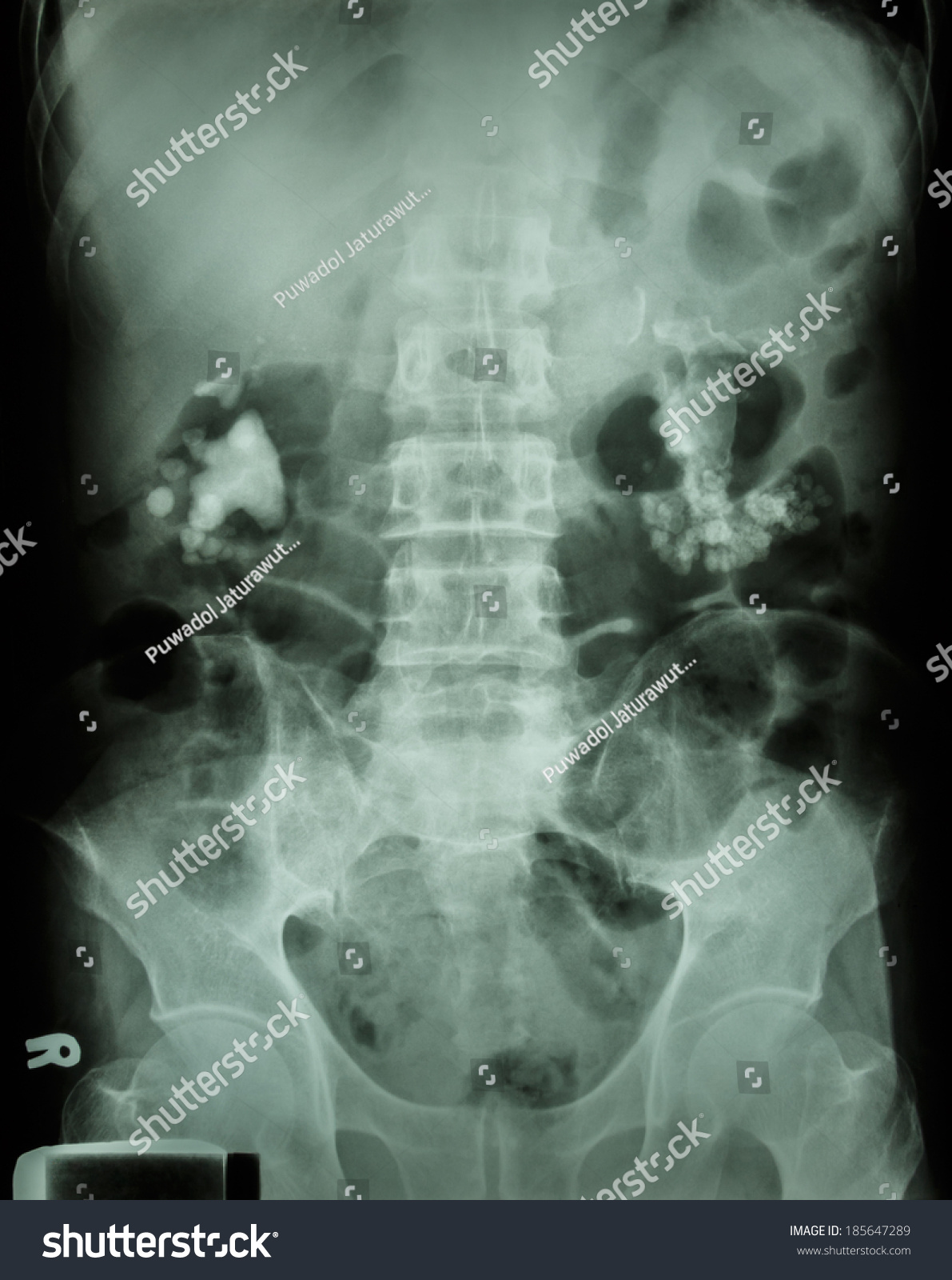 Bilateral Renal Calculistaghorn Stock Photo (Edit Now) 185647289