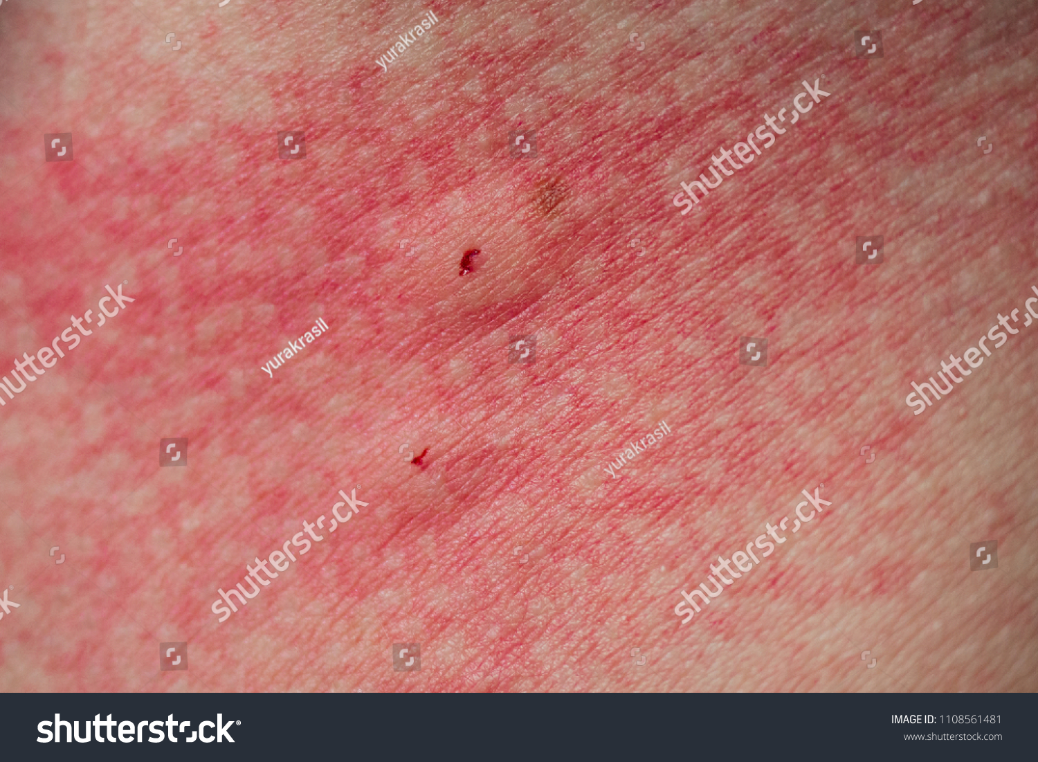 spider-bite-skin-images-stock-photos-vectors-shutterstock