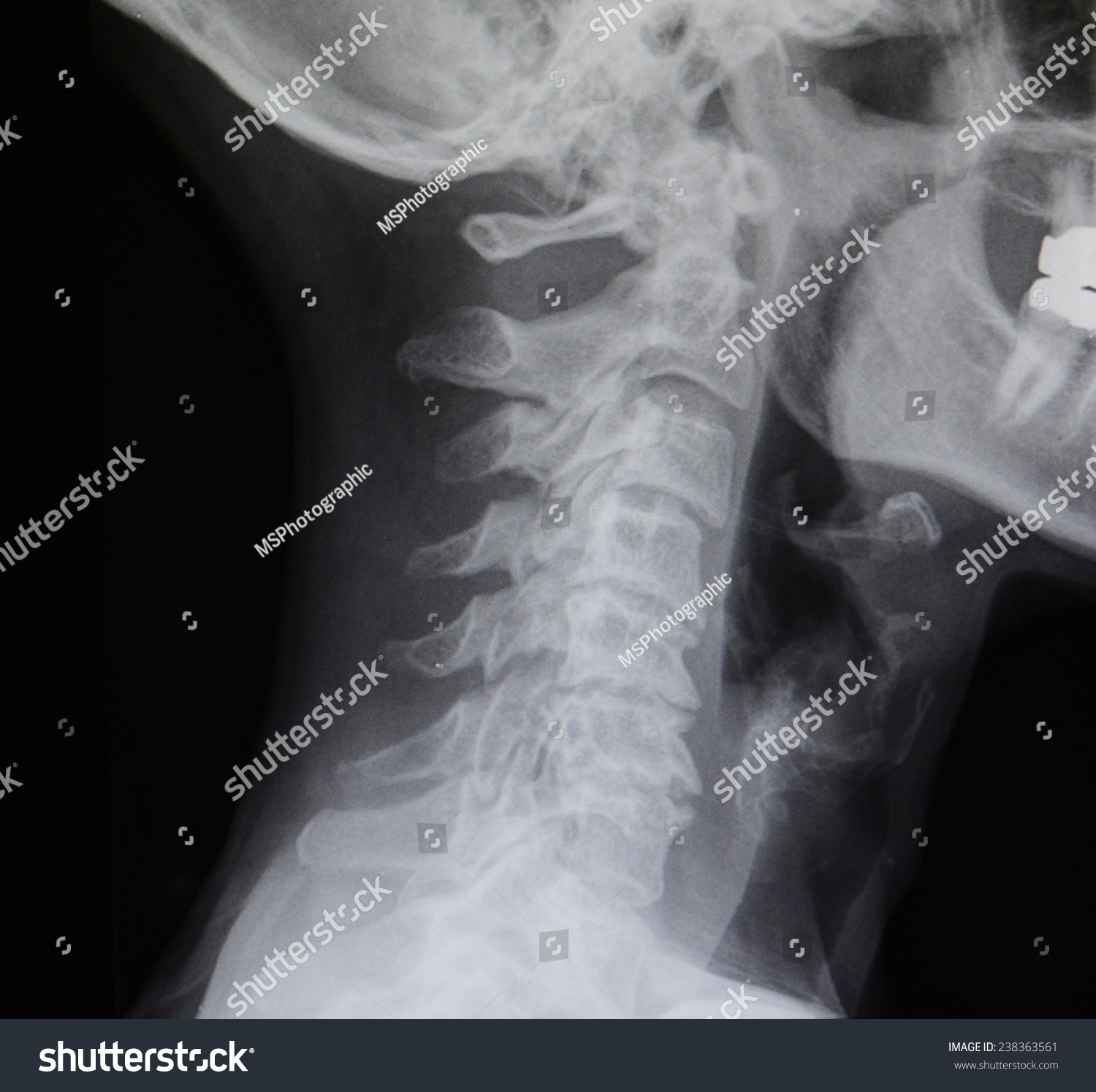 Black And White Digital X-Ray Of A Human Spine Stock Photo 238363561 ...