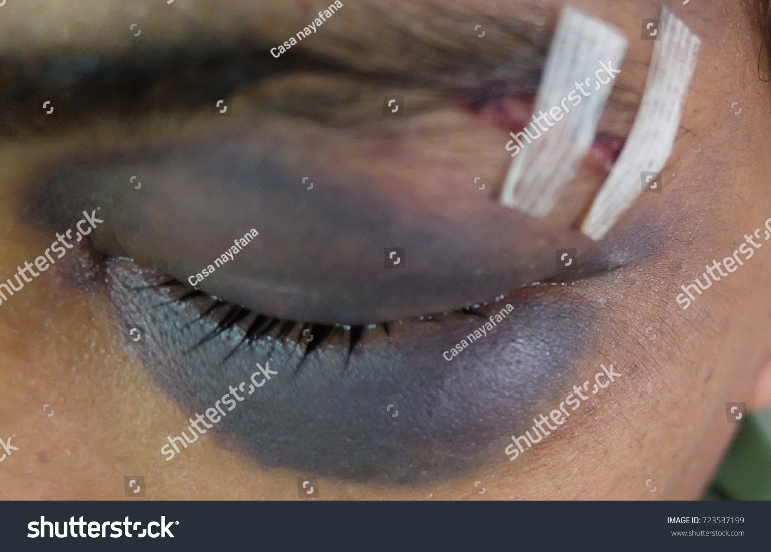 Black Eye Racoon Eye Periorbital Hematoma Stockfoto Shutterstock