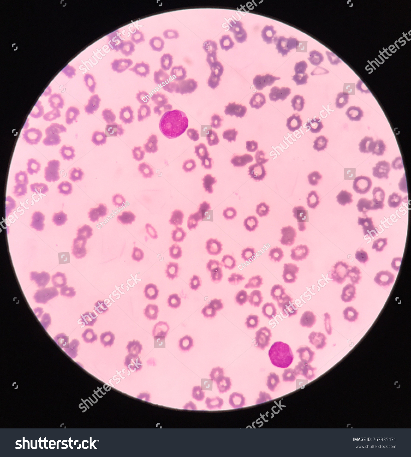 Blast Cells On Blood Smear Stock Photo 767935471 | Shutterstock