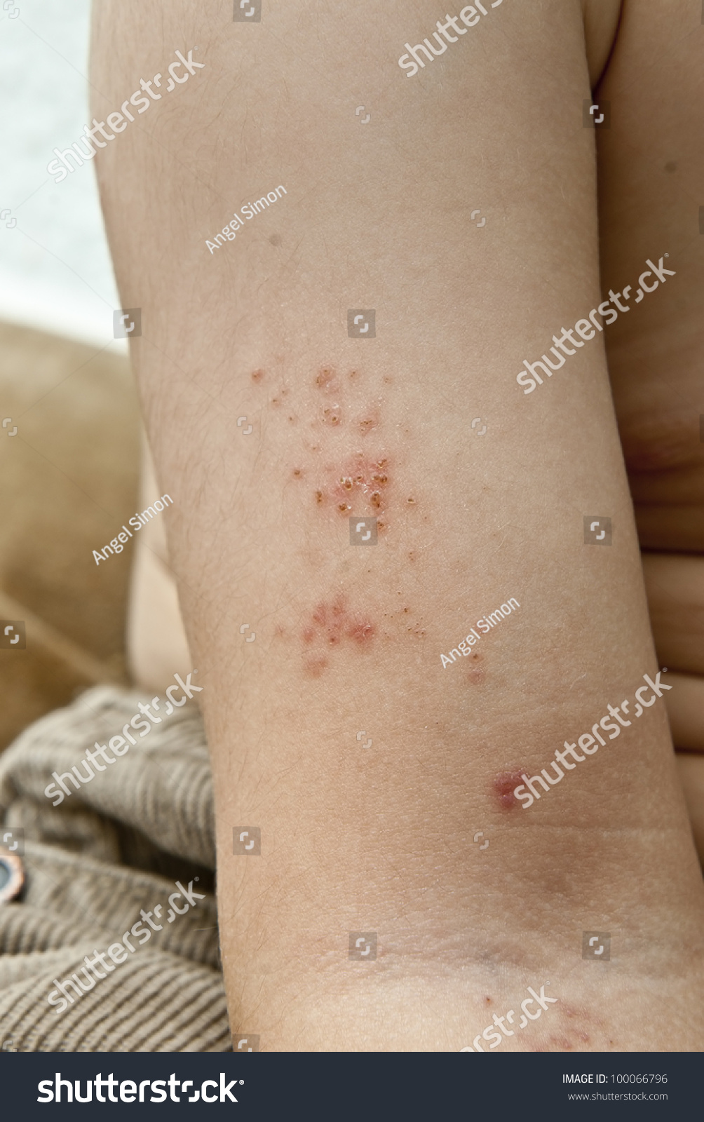 Blisters Caused By Herpes Zoster In The Hand And Arm Of A Child. Stock ...