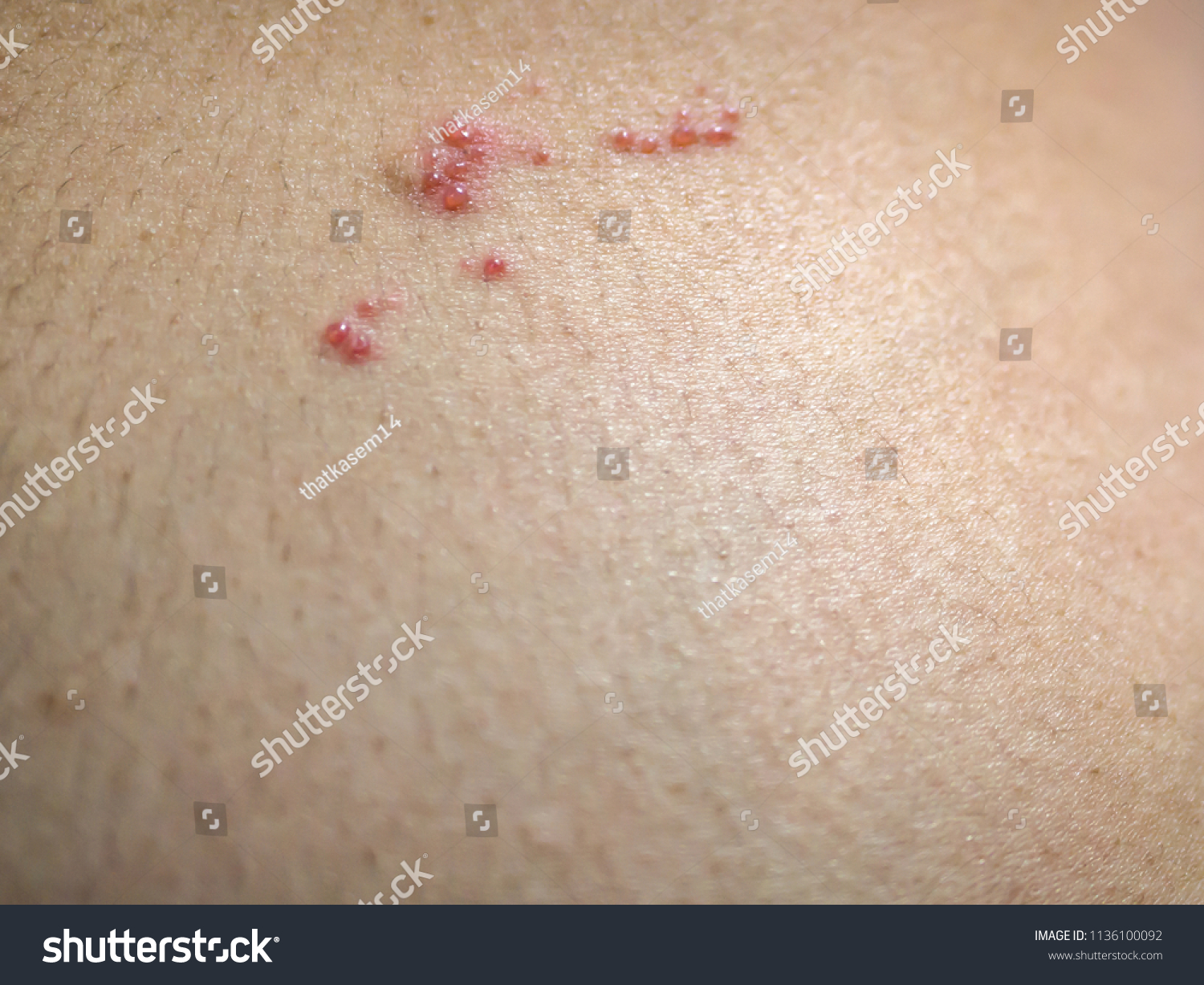 Blisters Shingles Beginning Stock Photo Edit Now