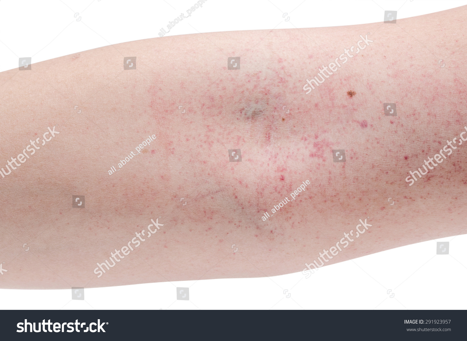 Blood Rush At Arm From Dengue Fever Stock Photo 291923957 : Shutterstock