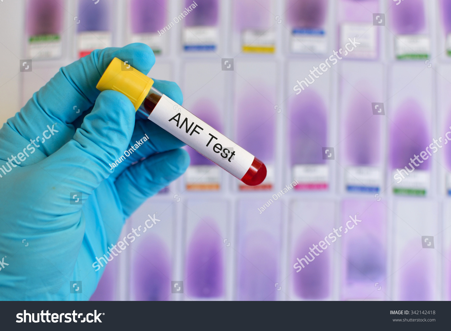 Blood Sample Antinuclear Factor Anf Testing Stock Photo 342142418 ...