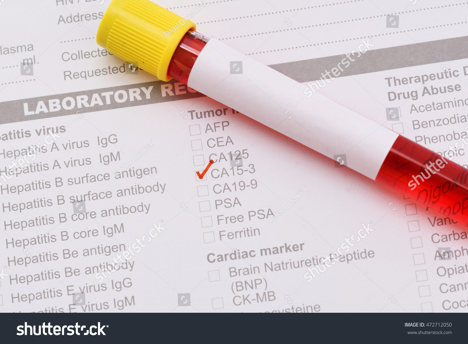 Blood Sample Ca153 Test Breast Cancer Stock Photo 472712050 Shutterstock