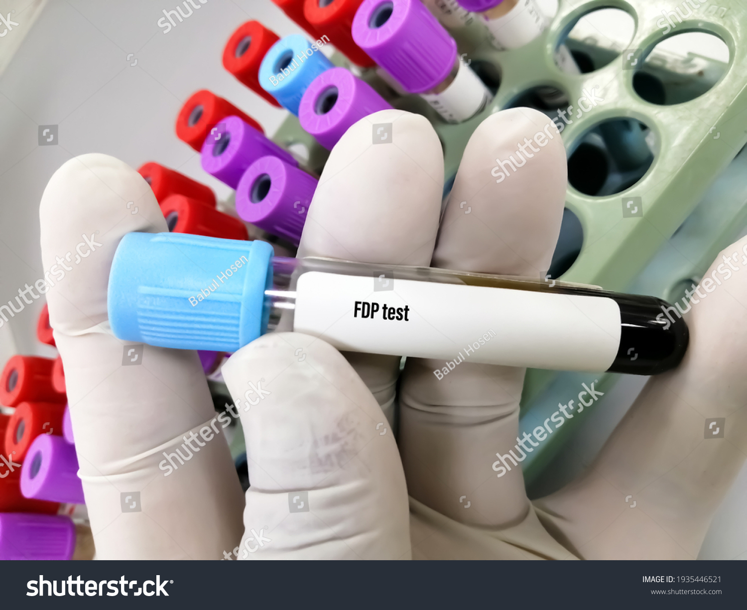 Blood Sample Fdp Fibrin Degradation Product Stock Photo 1935446521 ...