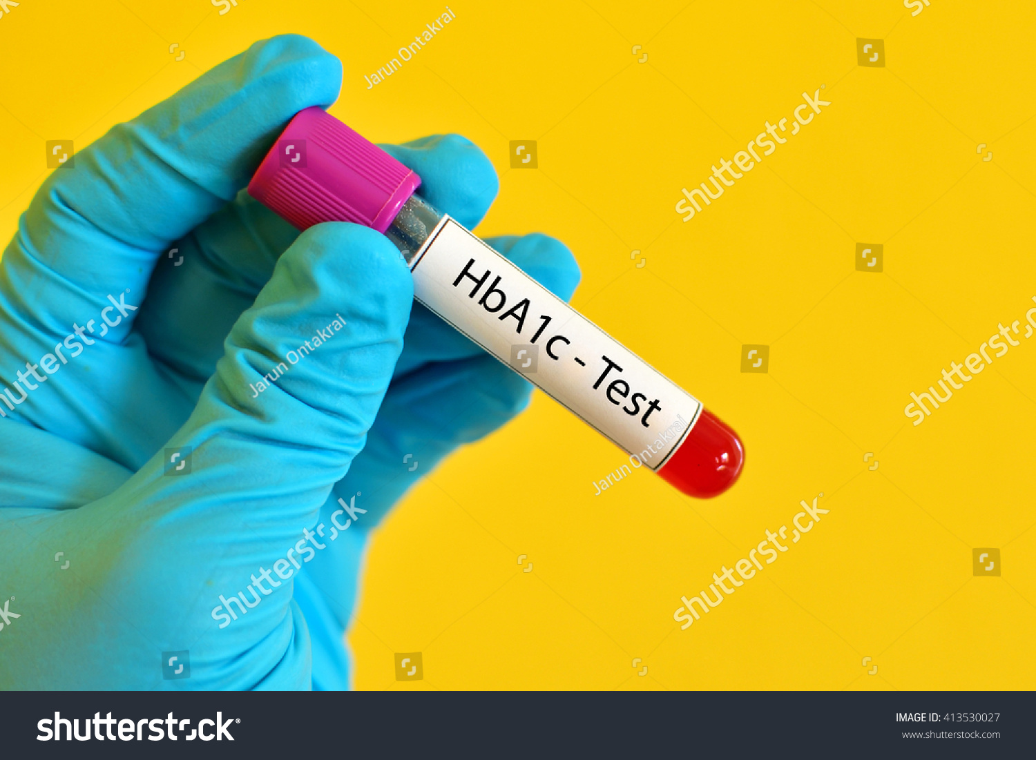 Blood Sample Hemoglobin A C Hba C Test