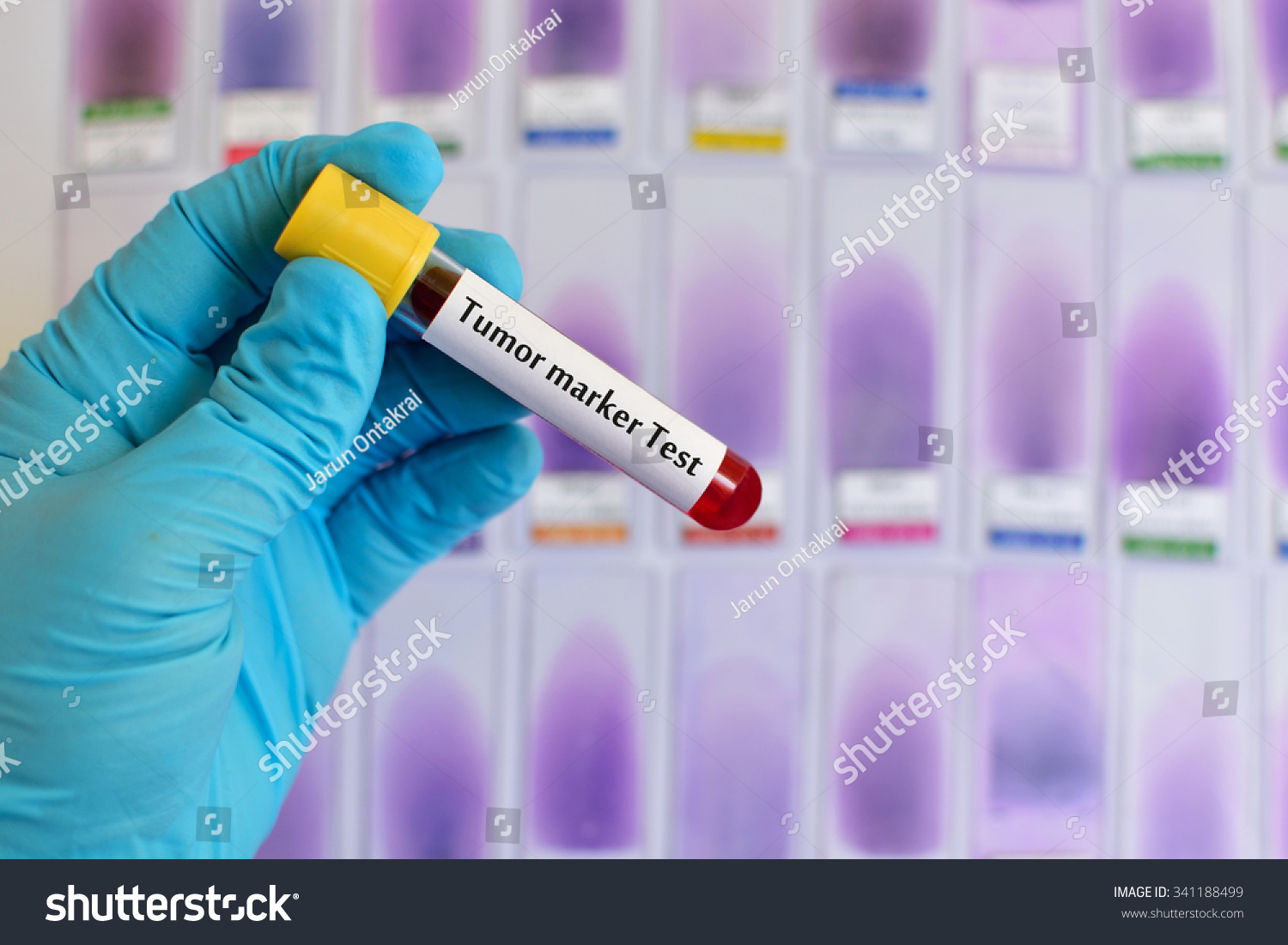 blood-sample-tumor-marker-testing-stock-photo-341188499-shutterstock