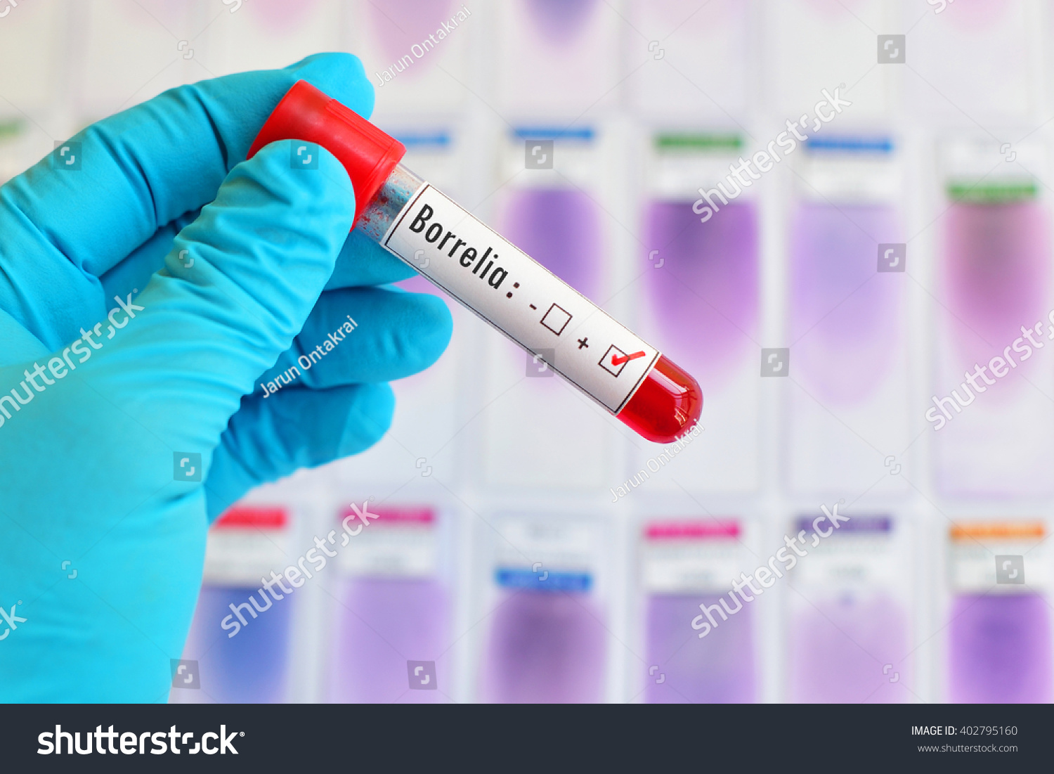 Blood Sample Positive Borrelia Test Lyme Stock Photo (Edit Now) 402795160