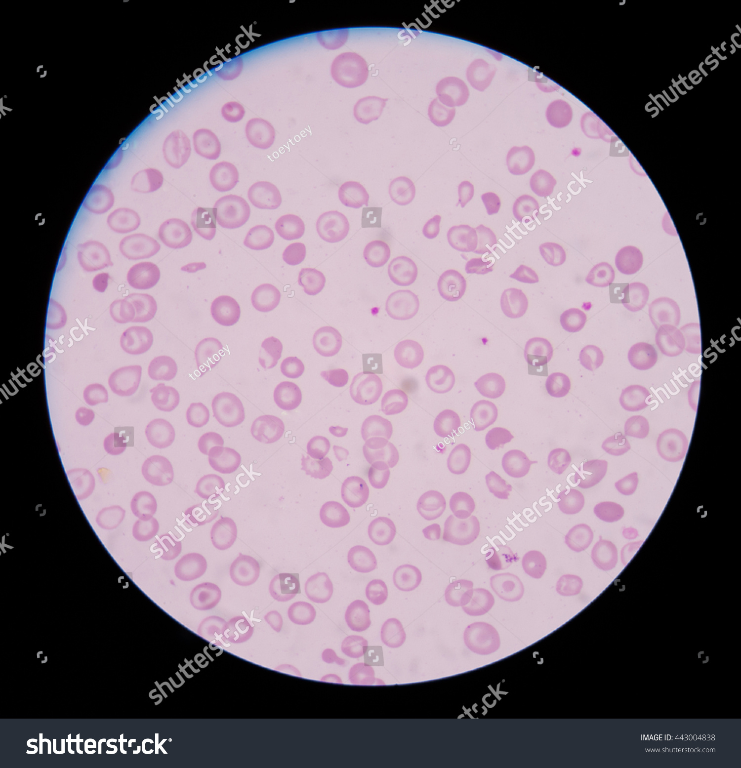 Blood Smear Cbc Test Showing Abnormal Stock Photo 443004838 | Shutterstock