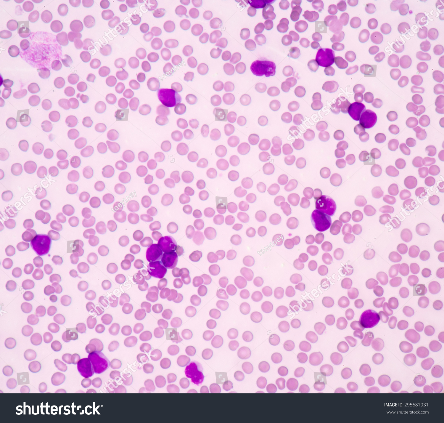 Blood Smear Show Acute Myeloblastic Leukemia(Aml).The Smear Shows Large ...